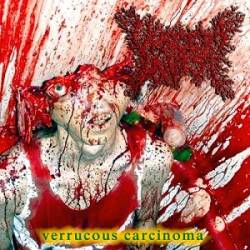 Viscera Infest : Verrucous Carcinoma Viscera Infest : Verrucous Carcinoma